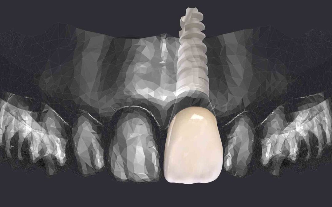 Implantologia Computer Guidata