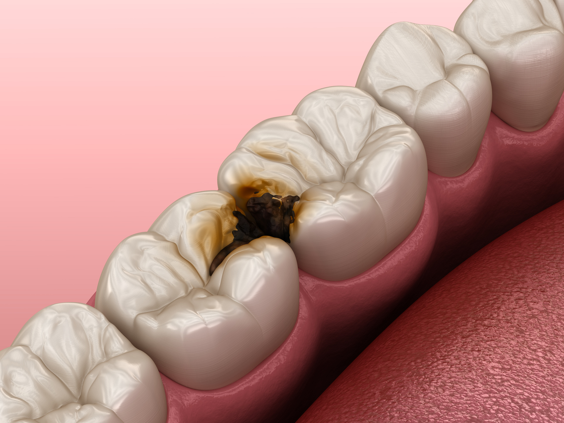 Molar teeth damaged by caries. Medically accurate tooth 3D illustration.